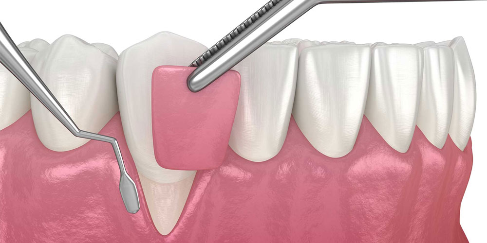 Gum Surgery Procedure