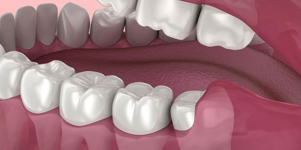 Wisdom Tooth Removal Techniques